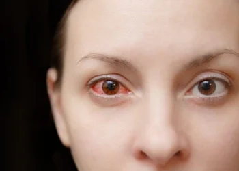 Mata Anda Sering Merah ? Yuk Kenali Penyebabnya